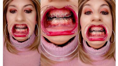 Braces fetish! See Alexandra Braces with an open mouth expander - 1 image