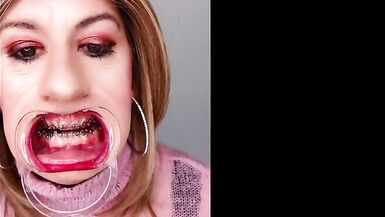 Braces fetish! See Alexandra Braces with an open mouth expander - 10 image