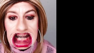 Braces fetish! See Alexandra Braces with an open mouth expander - 11 image