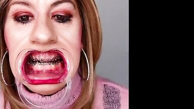 Braces fetish! See Alexandra Braces with an open mouth expander - 12 image