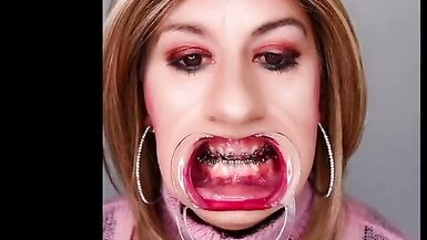 Braces fetish! See Alexandra Braces with an open mouth expander - 15 image