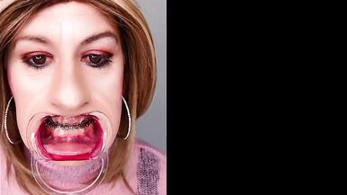 Braces fetish! See Alexandra Braces with an open mouth expander - 4 image