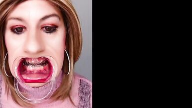Braces fetish! See Alexandra Braces with an open mouth expander - 6 image