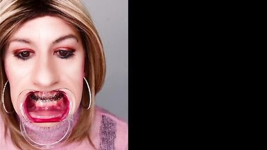 Braces fetish! See Alexandra Braces with an open mouth expander - 7 image