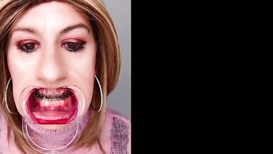 Braces fetish! See Alexandra Braces with an open mouth expander - 8 image