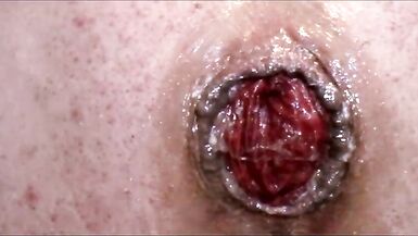 Anal Stuffing and Prolapse Banging 15m - 12 image